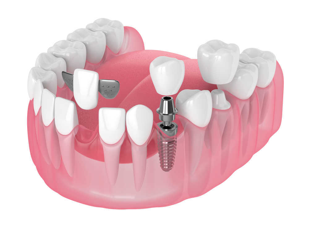 Implante dental VS Puente dental: ¿cuál es mejor?
