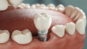 Beneficios de los implantes dentales